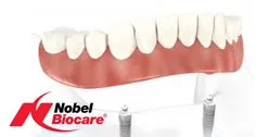Photo: Nobel Biocare's full lower denture on 4 dental implants